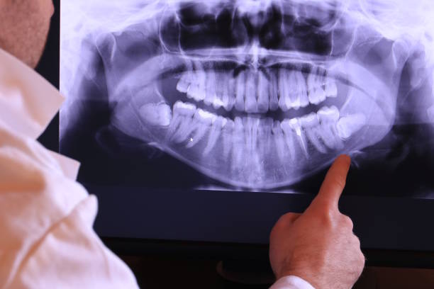 Best Emergency Tooth Extraction in Panthersville, GA